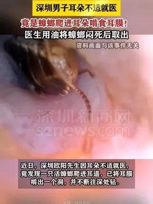 深圳男子耳朵不适就医，发现活蟑螂爬进耳膜啃出洞
