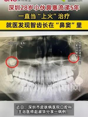 深圳28岁小伙鼻塞流涕5年，医生竟从他“鼻窦”里拔出智齿
