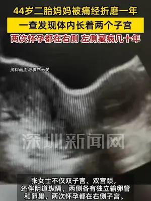 44岁二胎妈妈被痛经折磨，就医发现体内两个子宫