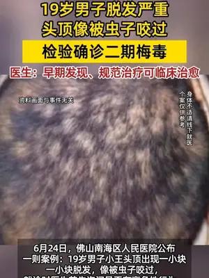 19岁男子脱发严重竟查出二期梅毒