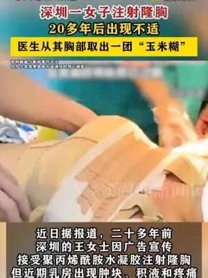 深圳一女子注射隆胸20多年后出现不适，医生从其胸部取出一团“玉米糊”