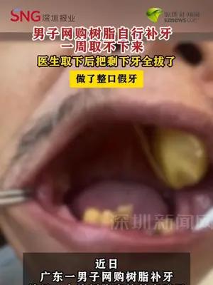 男子网购树脂自行补牙一周取不下来  医生取下后把剩下牙全拔了，做了整口假牙