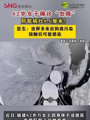 62岁女子确诊“虫癌”，肝脏病灶8.6厘米！ 医生：虫卵多来自狗粪污染，接触后可能感染