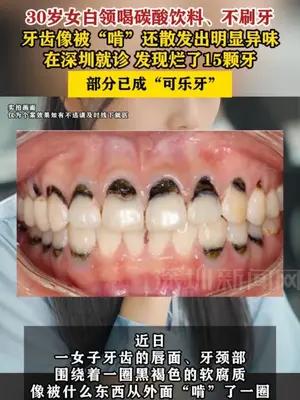 30岁女白领牙齿像被“啃” 就诊发现烂了15颗牙