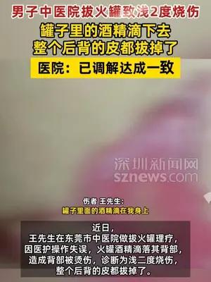 男子中医院拔火罐致浅2度烧伤