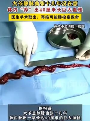 大爷静脉曲张没在意 体内“养”出40厘米长巨大血栓